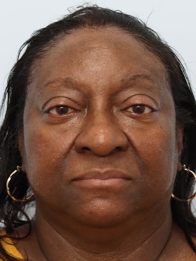 Rhinoplasty Before & After Gallery - Patient 860893 - Image 1