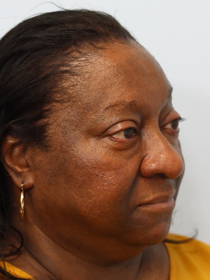 Rhinoplasty Before & After Gallery - Patient 860893 - Image 3