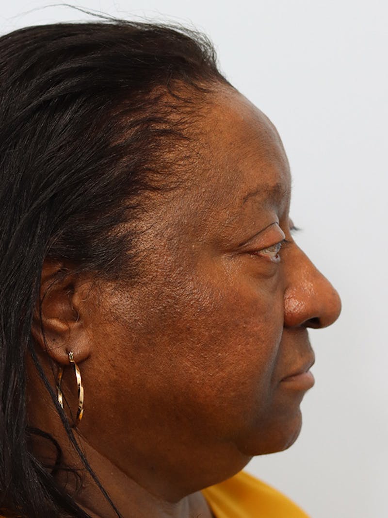 Rhinoplasty Before & After Gallery - Patient 860893 - Image 5
