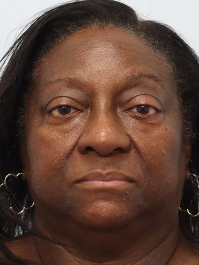 Rhinoplasty Before & After Gallery - Patient 860893 - Image 2