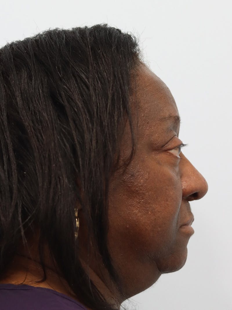 Rhinoplasty Before & After Gallery - Patient 860893 - Image 6