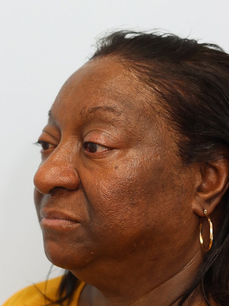 Rhinoplasty Before & After Gallery - Patient 860893 - Image 7