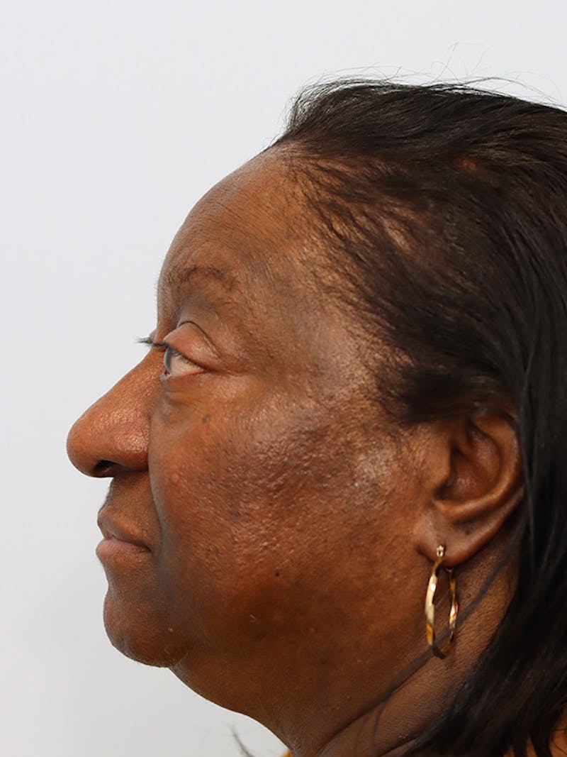 Rhinoplasty Before & After Gallery - Patient 860893 - Image 9