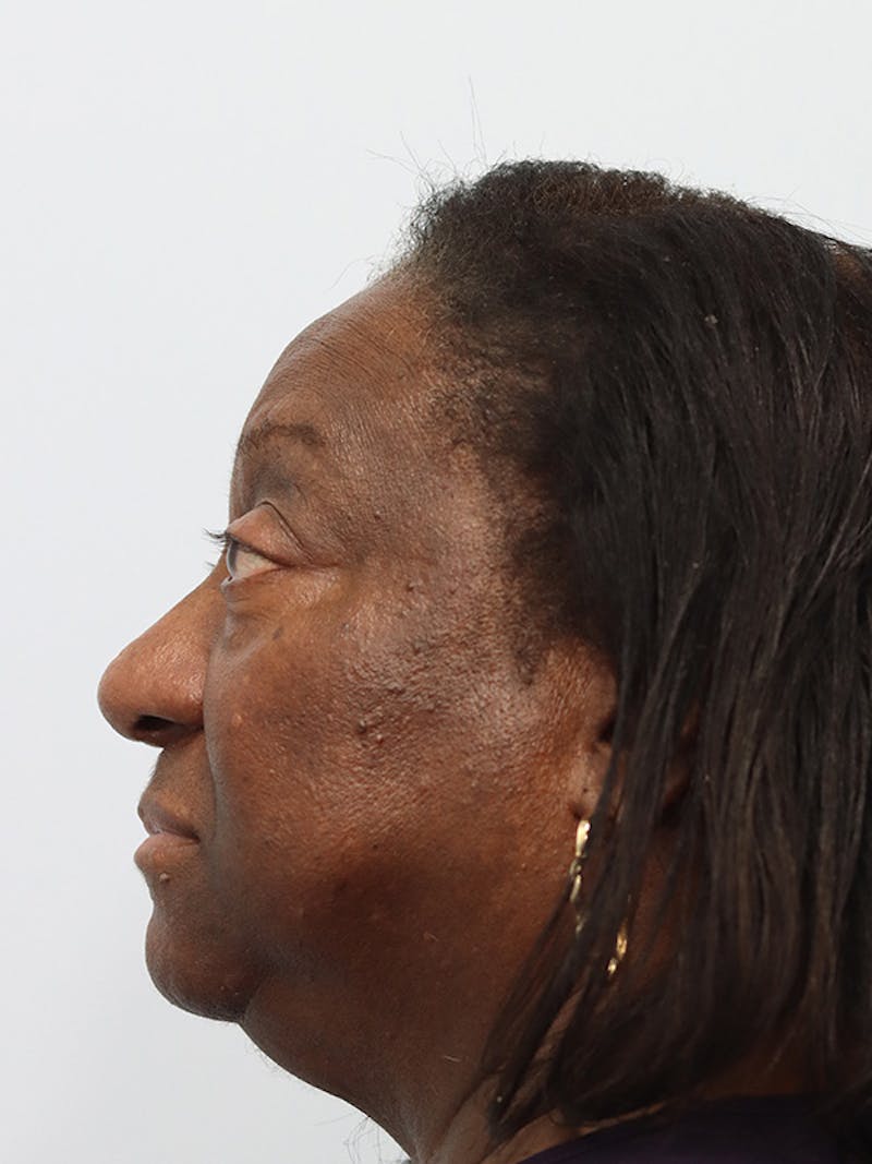 Rhinoplasty Before & After Gallery - Patient 860893 - Image 10