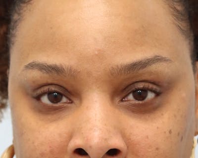 Upper Bleph frontal, eyes open- 3 months post-op