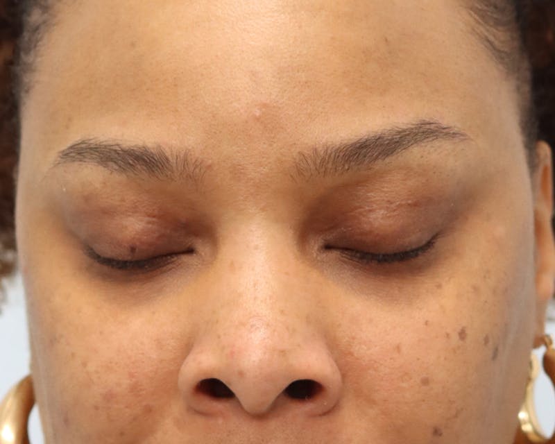 Upper Bleph frontal, eyes closed- 3 months post-op