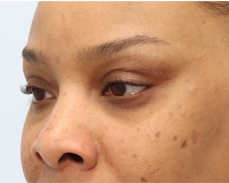 Upper Bleph left 3 quarter view- 3 months post-op