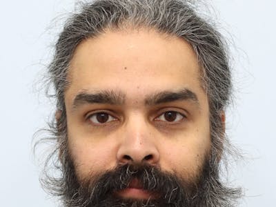 Reconstructive Before & After Gallery - Patient 387503 - Image 2