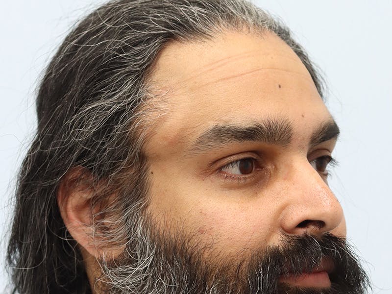 Reconstructive Before & After Gallery - Patient 387503 - Image 3