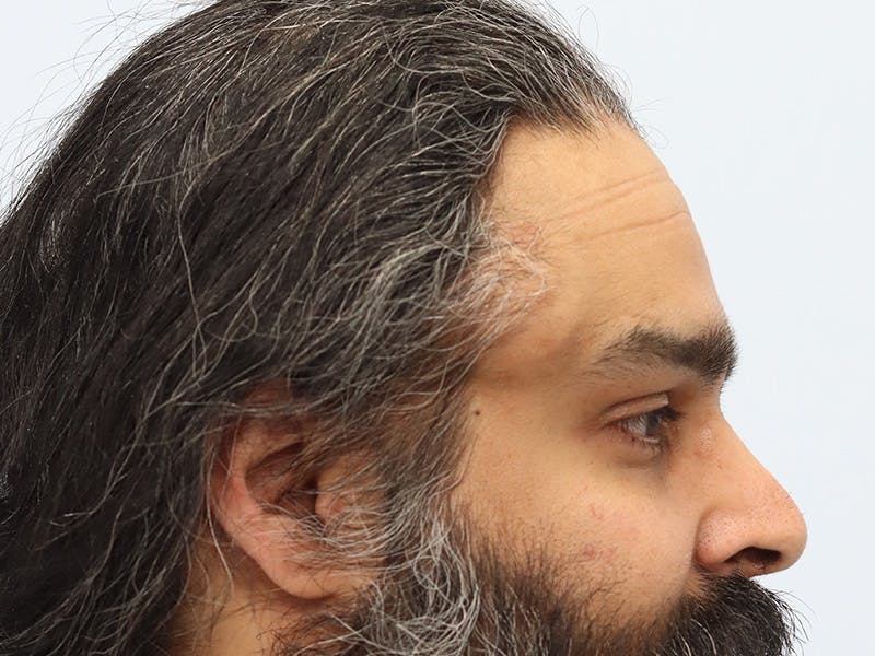 Reconstructive Before & After Gallery - Patient 387503 - Image 5