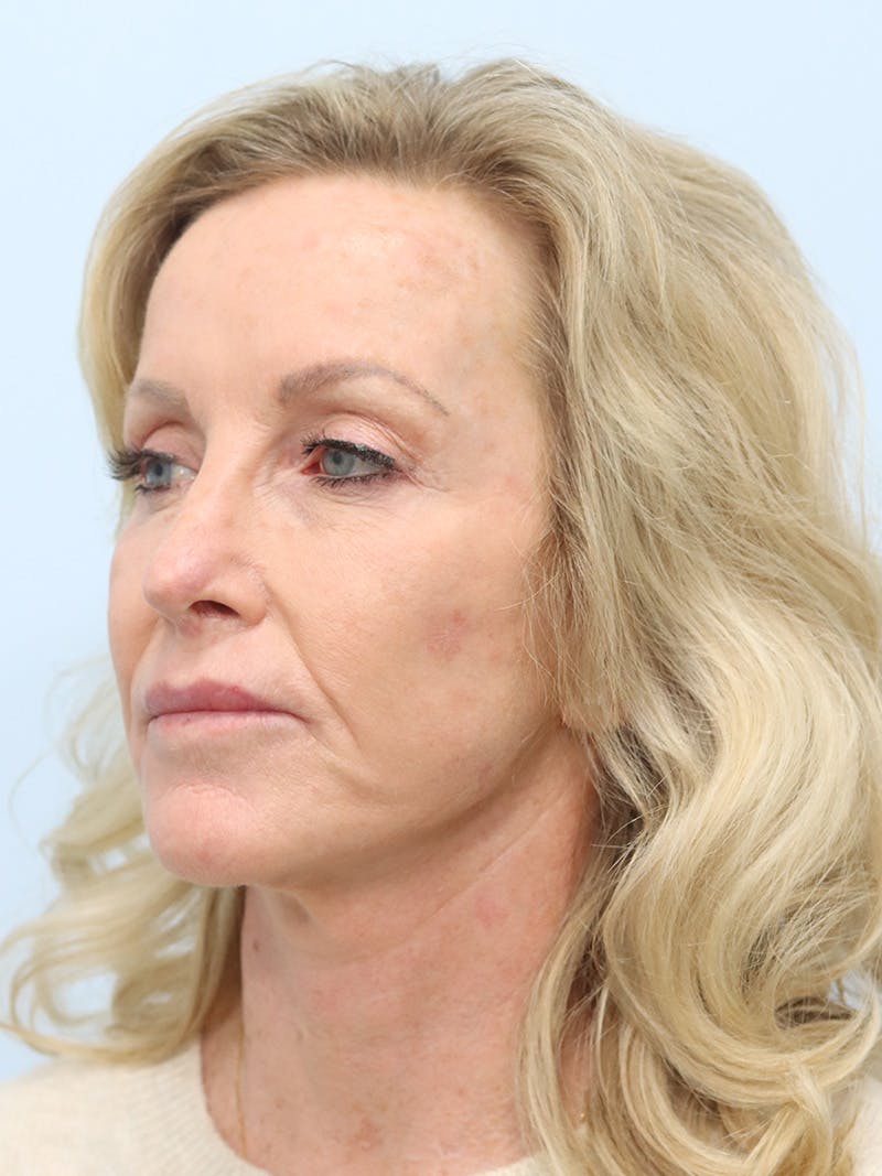 Facelift Before & After Gallery - Patient 218716 - Image 7