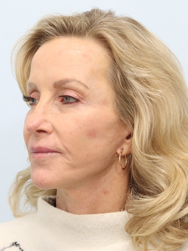 Facelift Before & After Gallery - Patient 218716 - Image 8