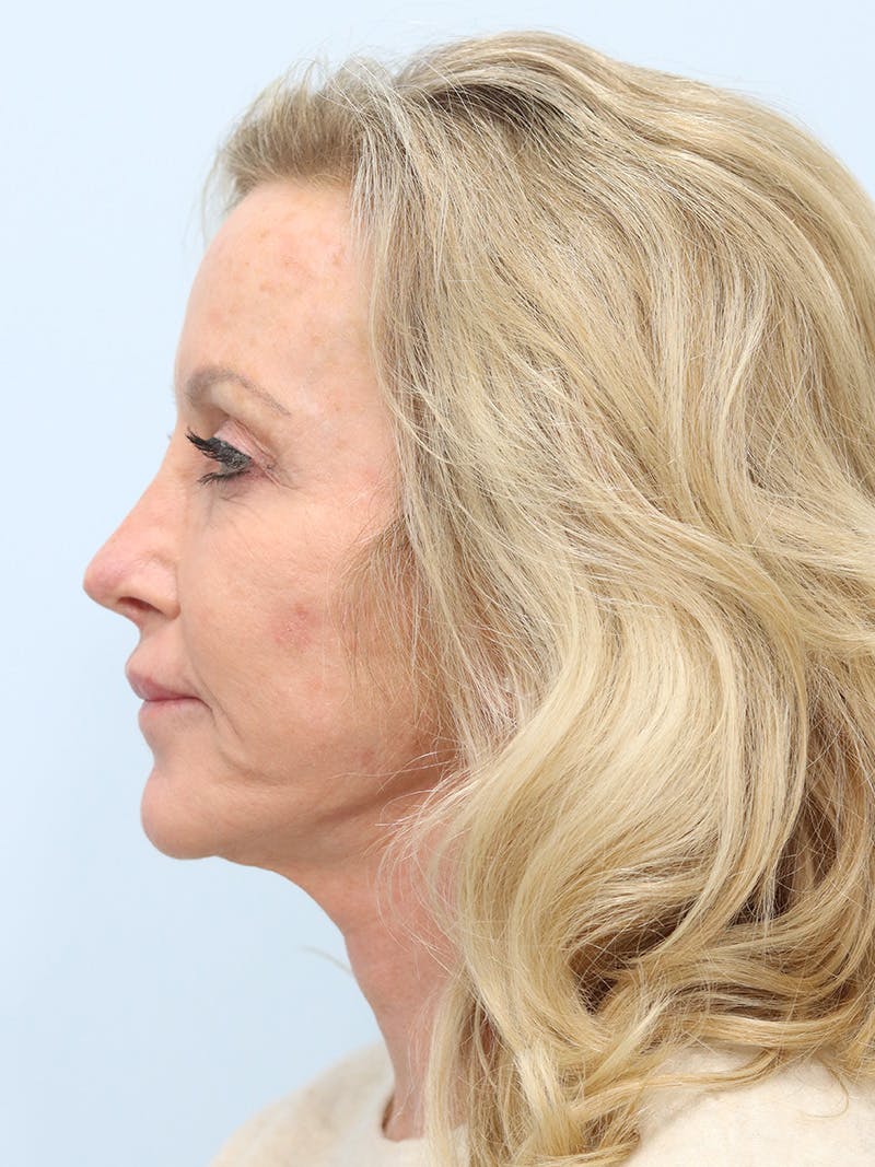 Facelift Before & After Gallery - Patient 218716 - Image 9