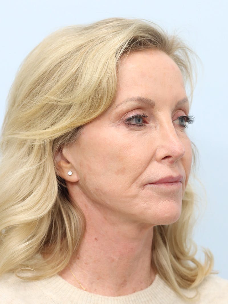 Facelift Before & After Gallery - Patient 218716 - Image 3