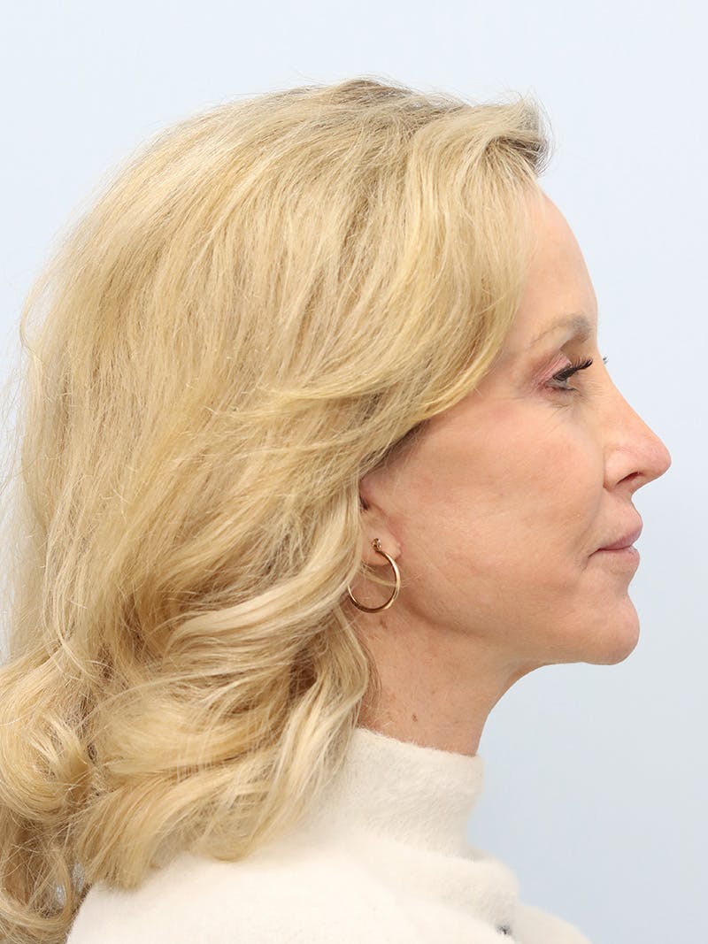 Facelift Before & After Gallery - Patient 218716 - Image 6