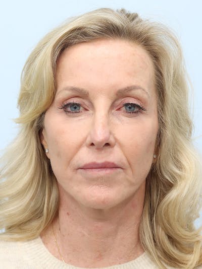 Facelift Before & After Gallery - Patient 218716 - Image 1