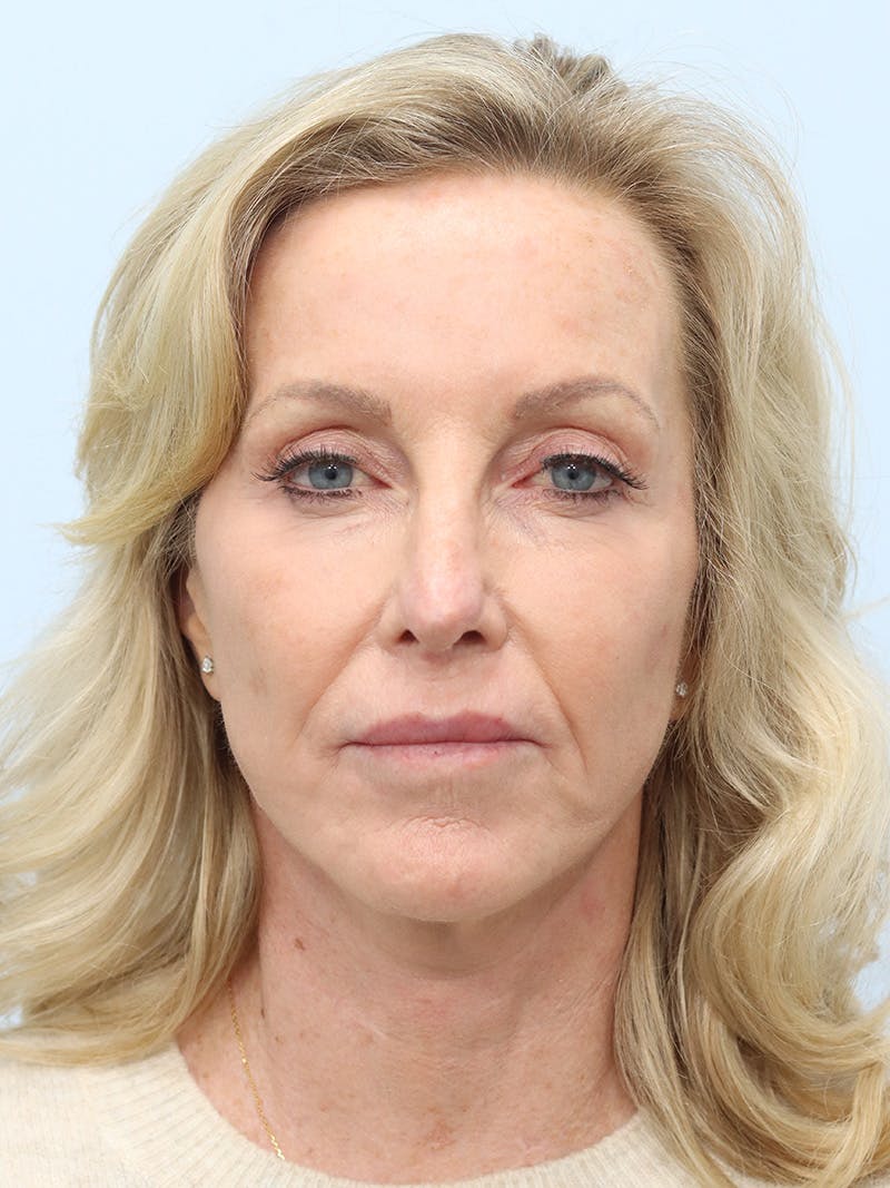 Facelift Before & After Gallery - Patient 218716 - Image 1