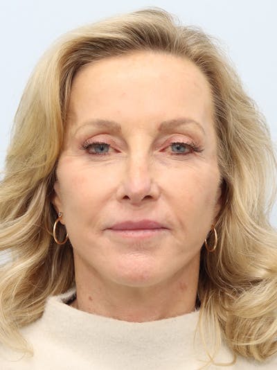 Facelift Before & After Gallery - Patient 218716 - Image 2