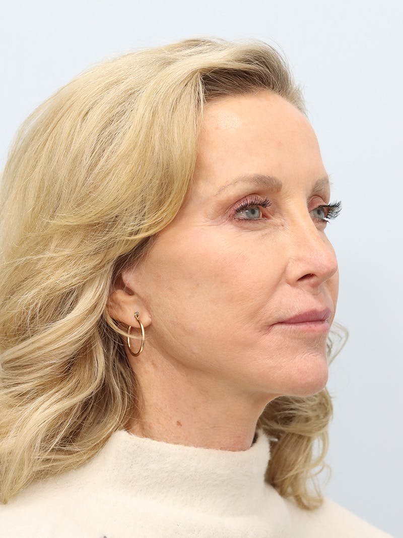 Facelift Before & After Gallery - Patient 218716 - Image 4