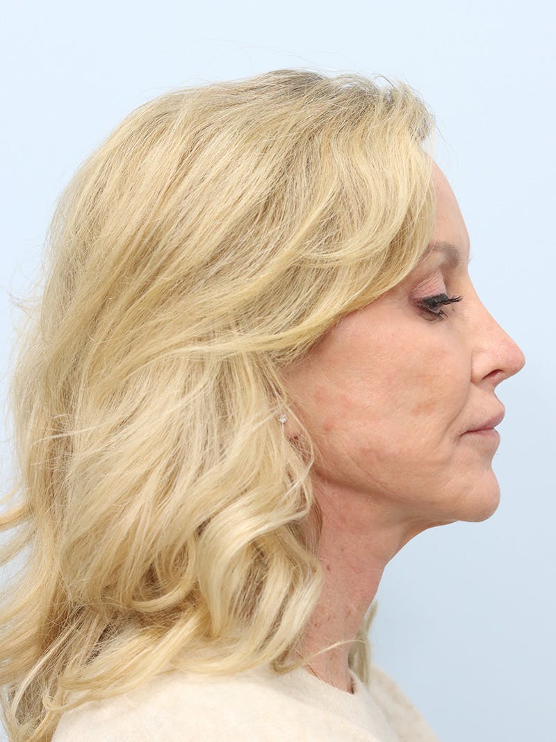 Facelift Before & After Gallery - Patient 218716 - Image 5