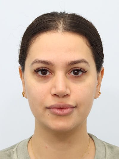 Laser Skin Treatment Before & After Gallery - Patient 370678 - Image 1