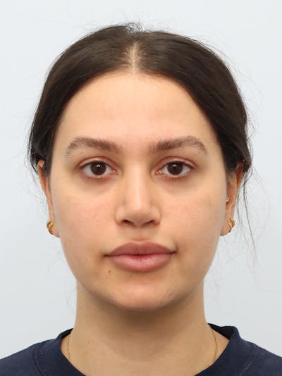 Laser Skin Treatment Before & After Gallery - Patient 370678 - Image 2