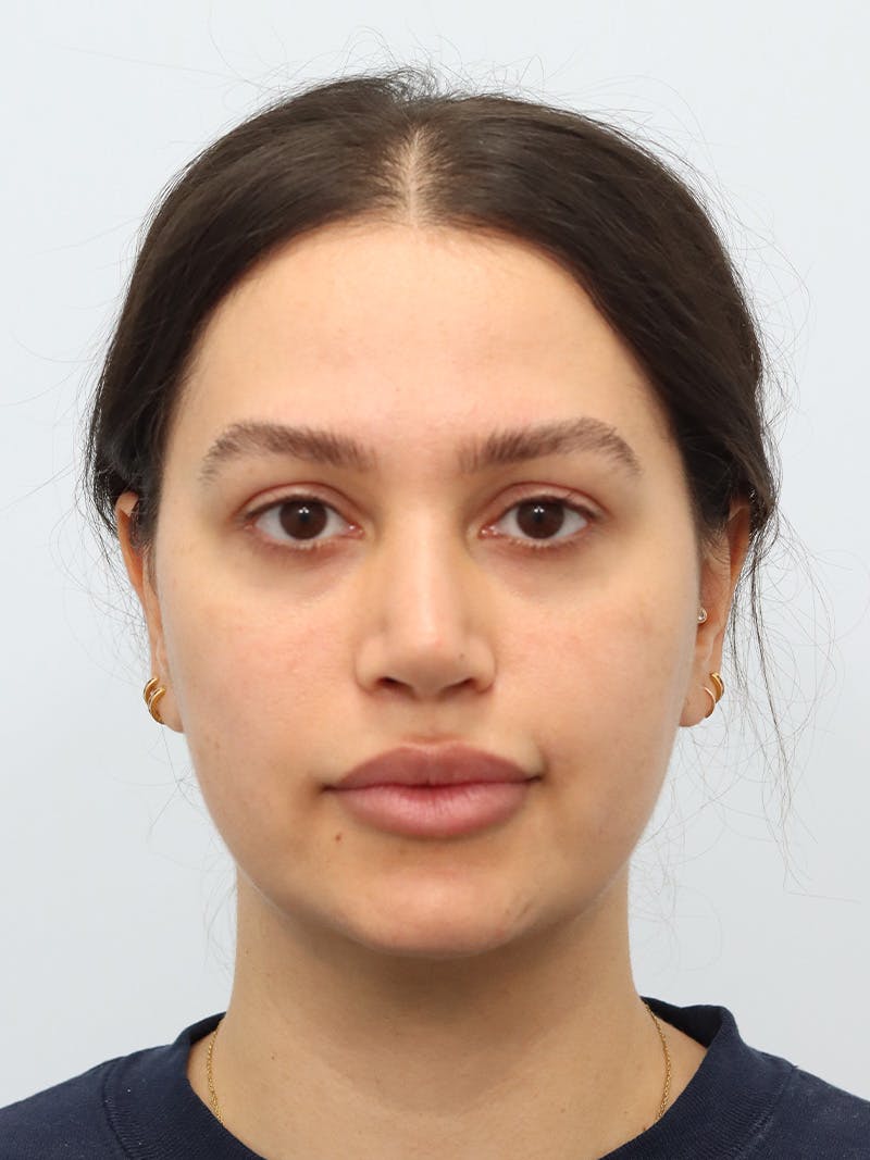 Laser Skin Treatment Before & After Gallery - Patient 370678 - Image 2