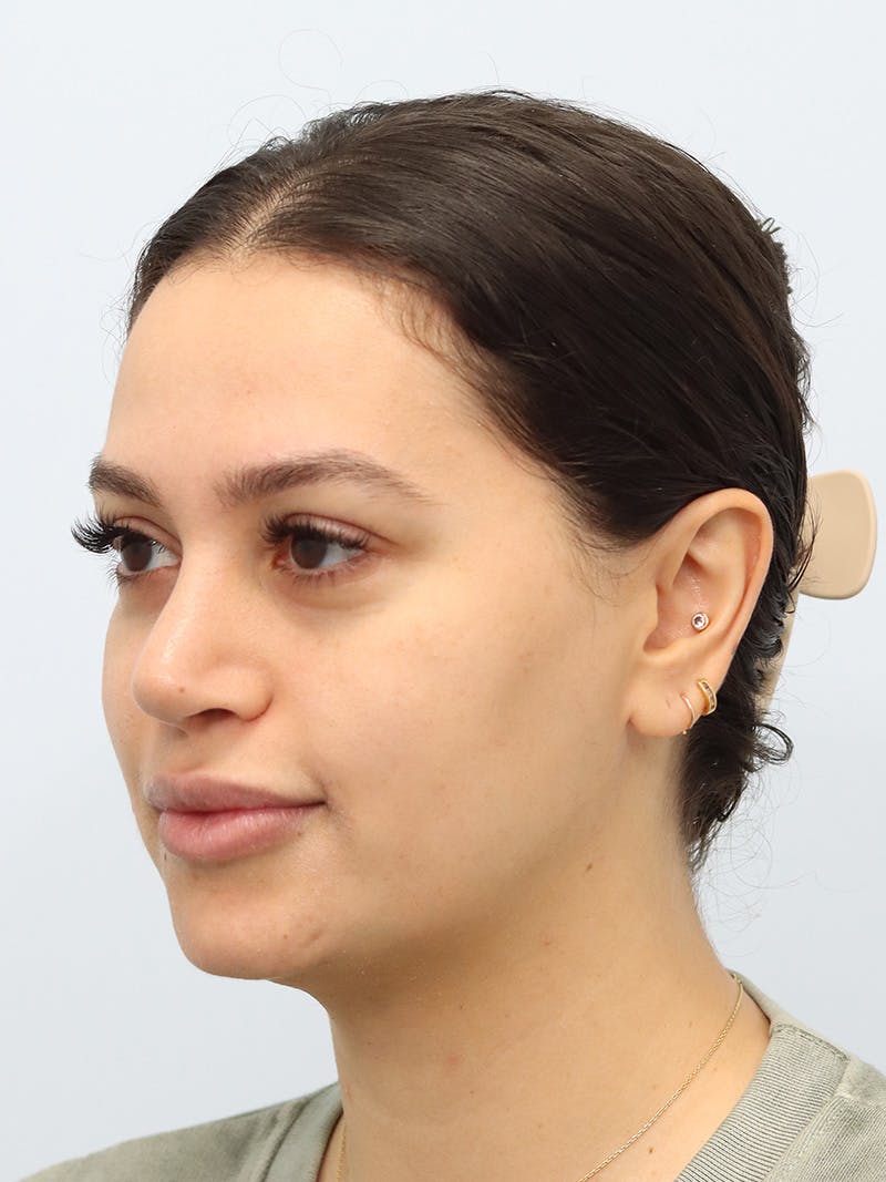 Laser Skin Treatment Before & After Gallery - Patient 370678 - Image 5