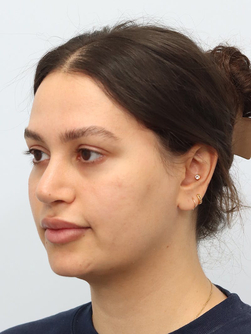 Laser Skin Treatment Before & After Gallery - Patient 370678 - Image 6