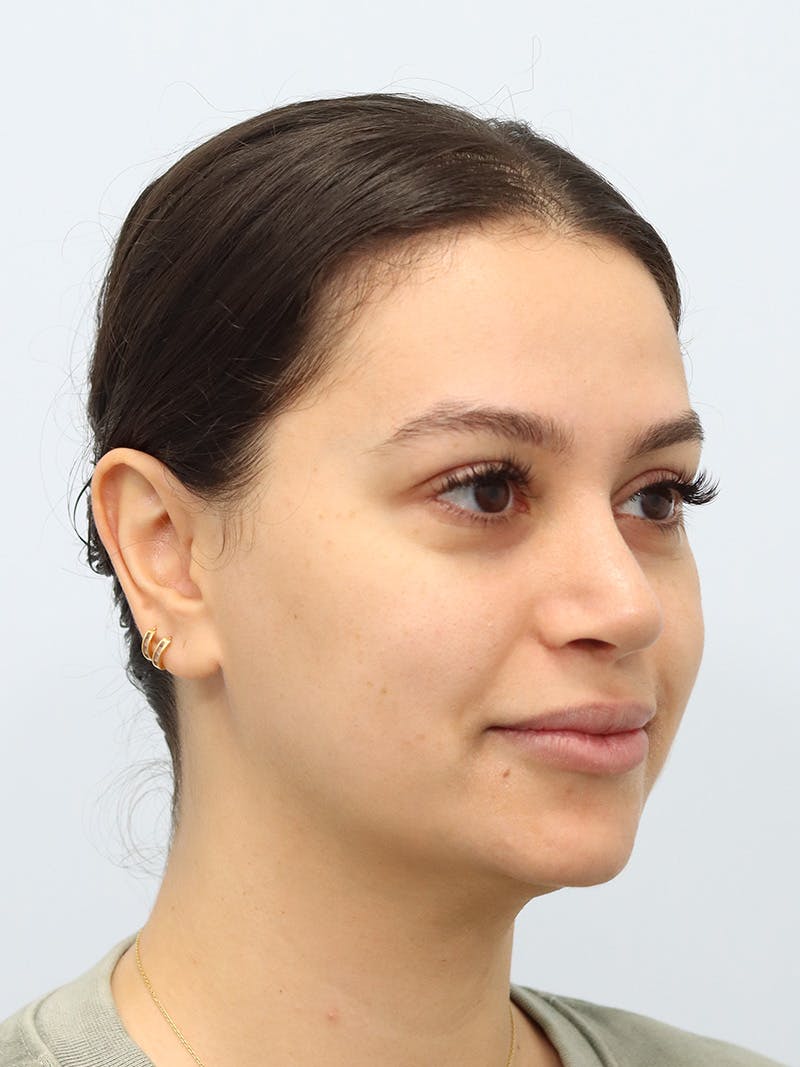 Laser Skin Treatment Before & After Gallery - Patient 370678 - Image 3