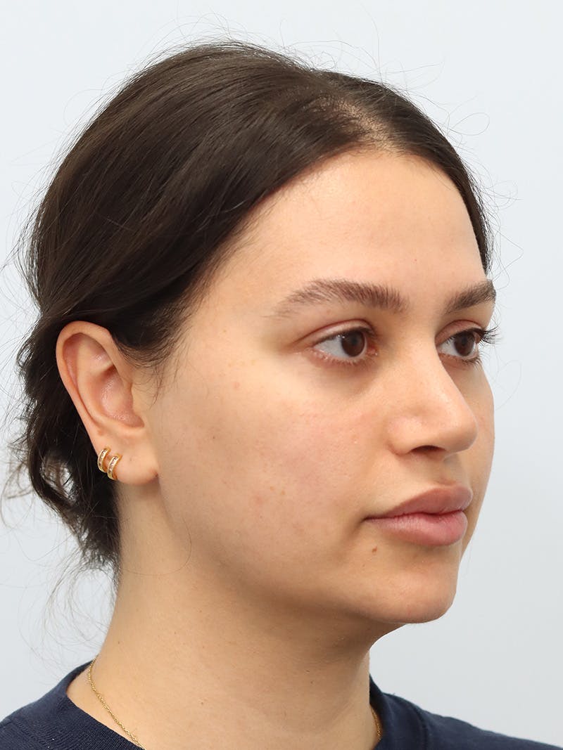 Laser Skin Treatment Before & After Gallery - Patient 370678 - Image 4