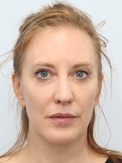 Facial Fat Transfer Before & After Gallery - Patient 313477 - Image 2