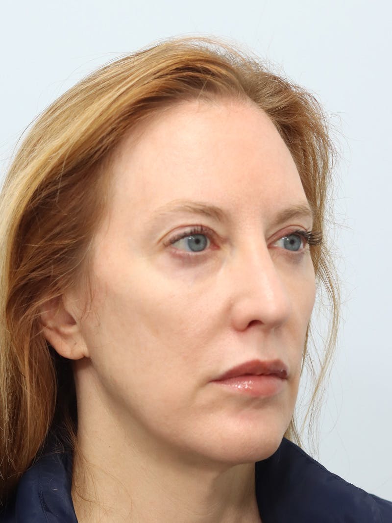 Facial Fat Transfer Before & After Gallery - Patient 313477 - Image 3