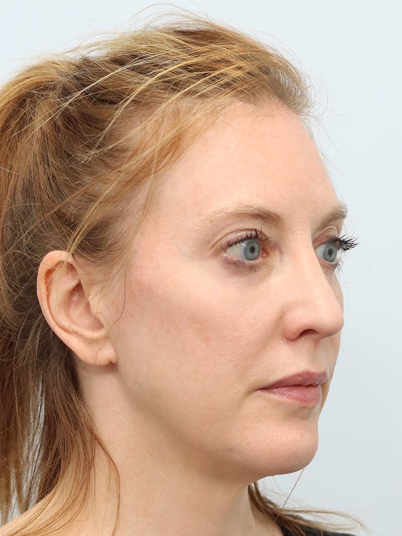 Facial Fat Transfer Before & After Gallery - Patient 313477 - Image 4