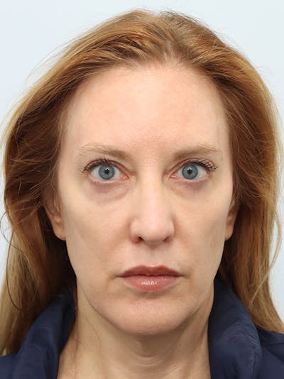 Facial Fat Transfer Before & After Gallery - Patient 313477 - Image 1