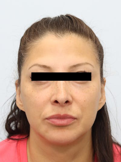 Facial Fat Transfer Before & After Gallery - Patient 401660 - Image 1