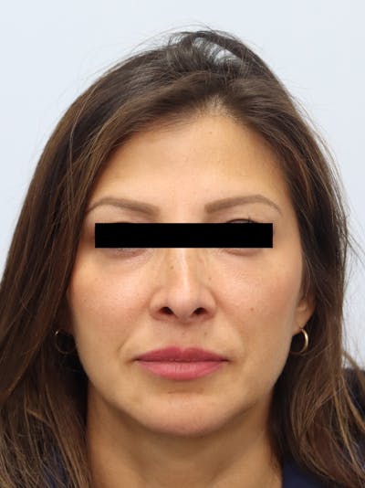 Facial Fat Transfer Before & After Gallery - Patient 401660 - Image 2