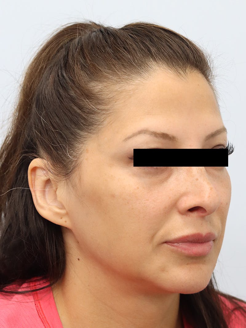 Facial Fat Transfer Before & After Gallery - Patient 401660 - Image 3