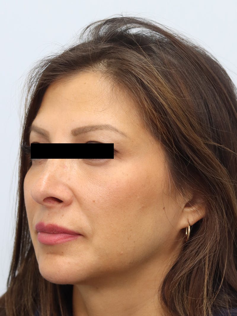 Facial Fat Transfer Before & After Gallery - Patient 401660 - Image 6