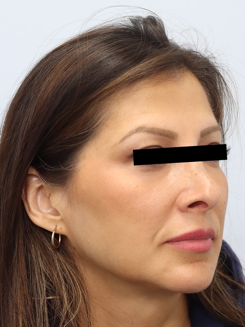 Facial Fat Transfer Before & After Gallery - Patient 401660 - Image 4