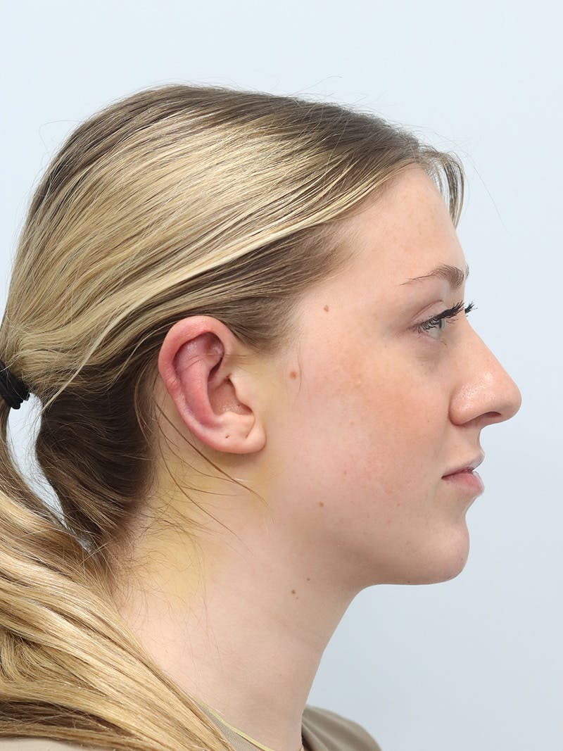 Otoplasty Before & After Gallery - Patient 629771 - Image 6