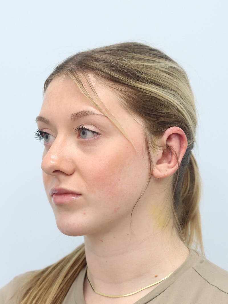 Otoplasty Before & After Gallery - Patient 629771 - Image 8