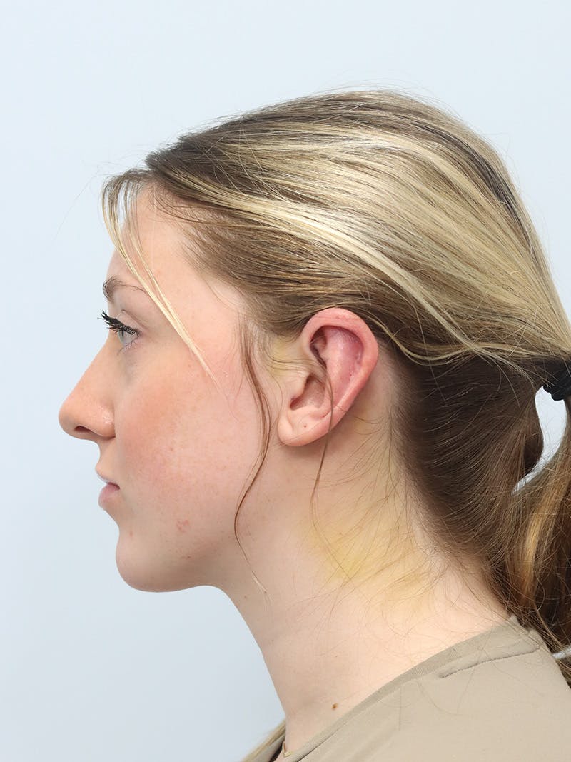 Otoplasty Before & After Gallery - Patient 629771 - Image 10