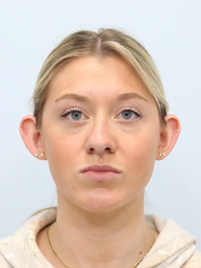 Otoplasty Before & After Gallery - Patient 629771 - Image 1