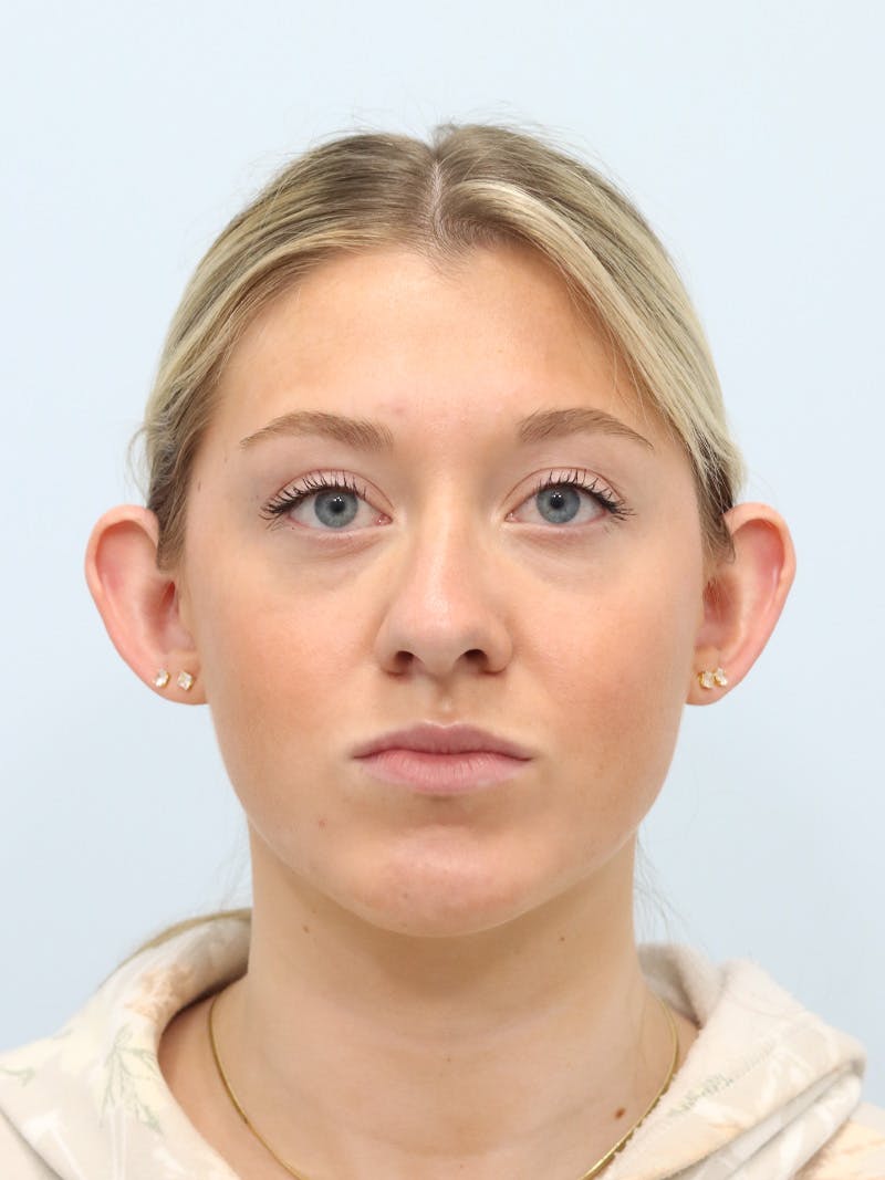 Otoplasty Before & After Gallery - Patient 629771 - Image 1