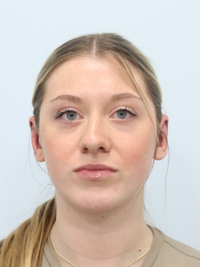 Otoplasty Before & After Gallery - Patient 629771 - Image 2