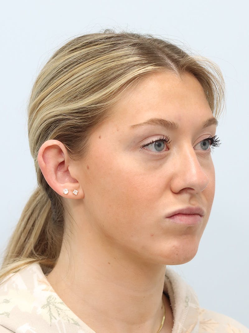 Otoplasty Before & After Gallery - Patient 629771 - Image 3