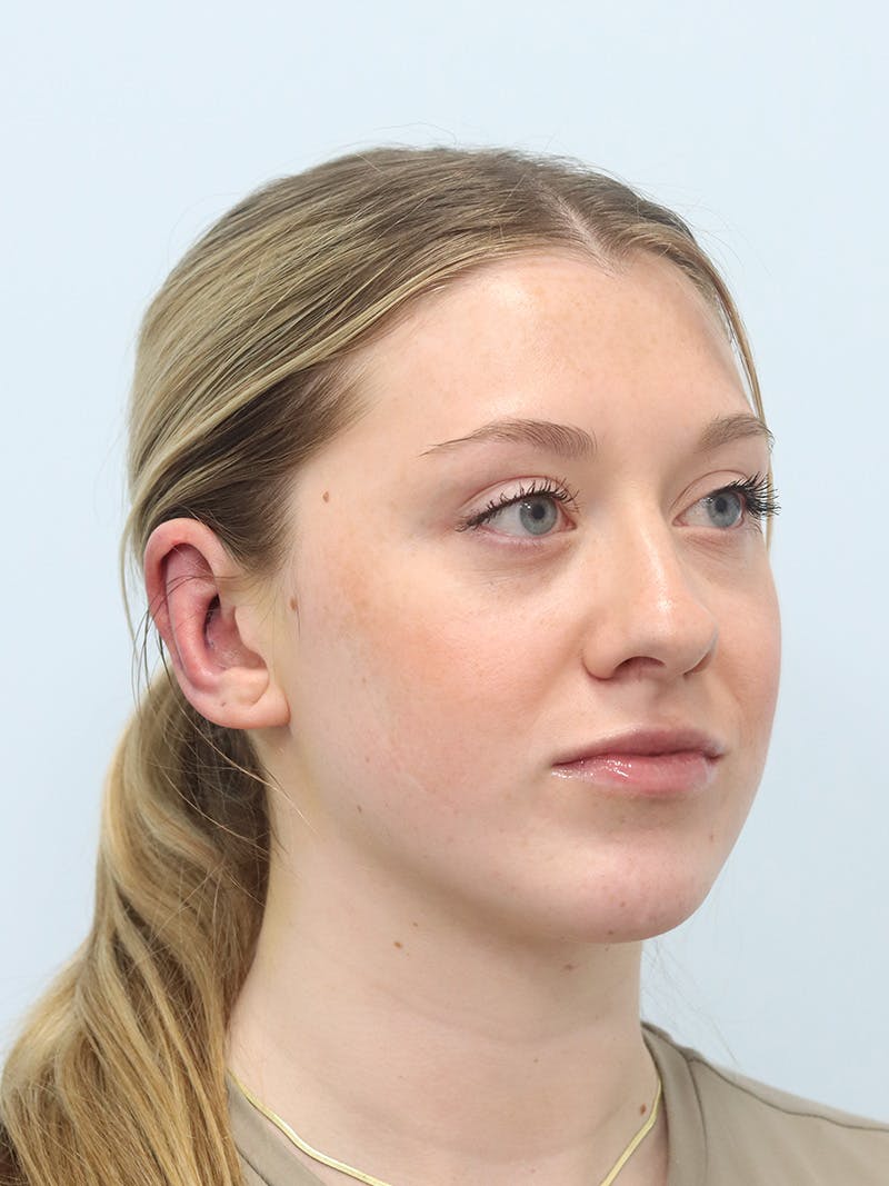 Otoplasty Before & After Gallery - Patient 629771 - Image 4