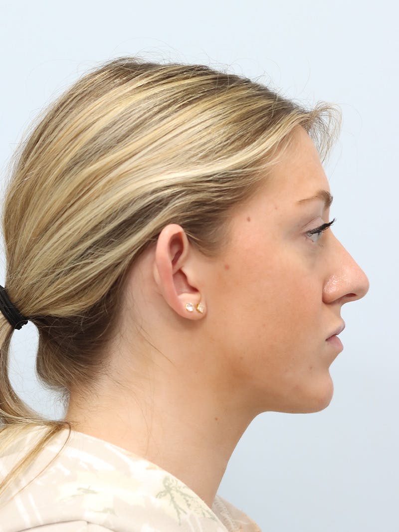 Otoplasty Before & After Gallery - Patient 629771 - Image 5