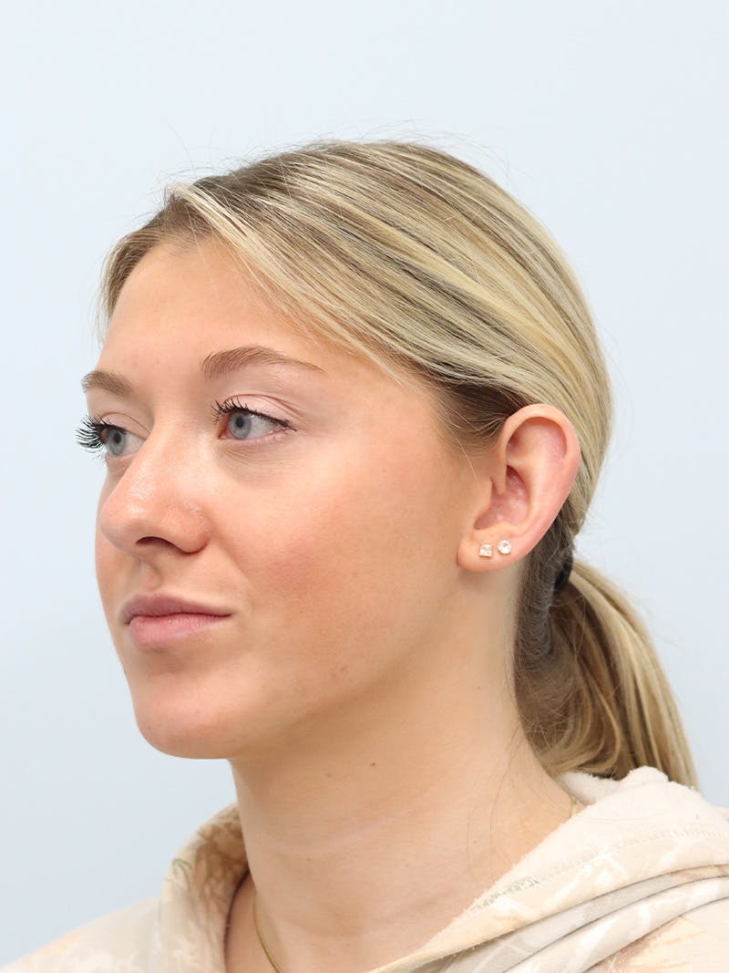 Otoplasty Before & After Gallery - Patient 629771 - Image 7